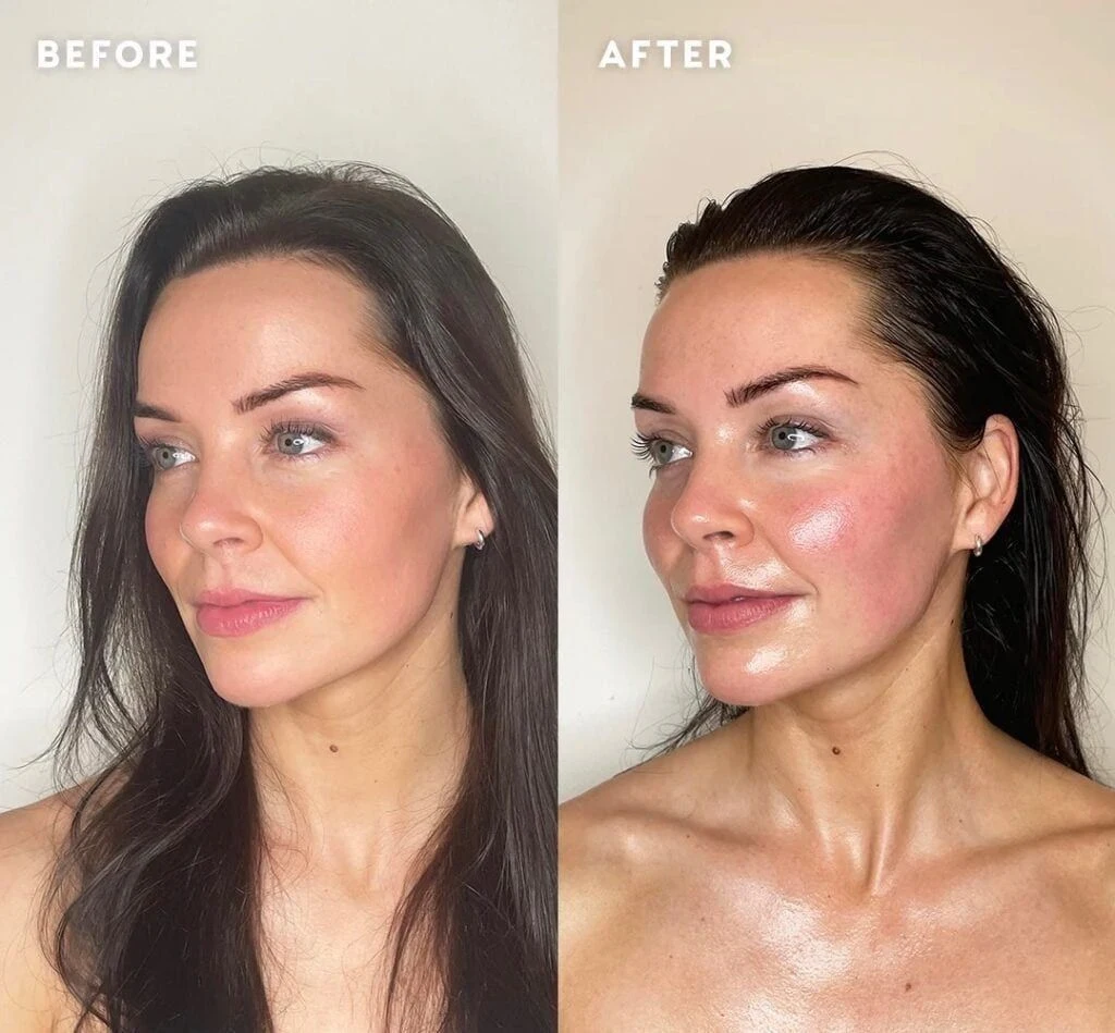 Acne · week 2